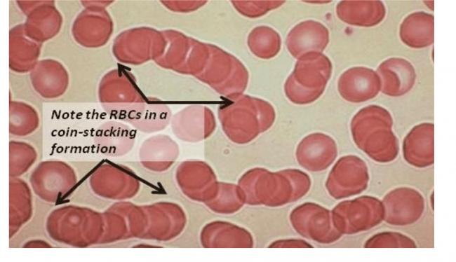 Coin-Stacking-of-RBC-Rouleaux-Formation-Courtesy-from.png